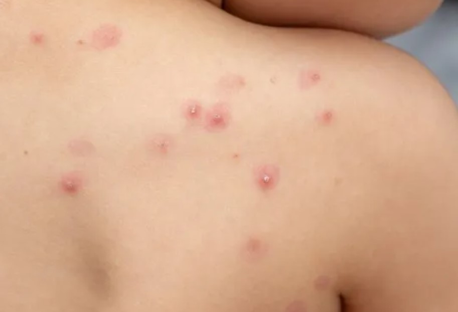 Viruela del mono: ya hay 22 casos confirmados