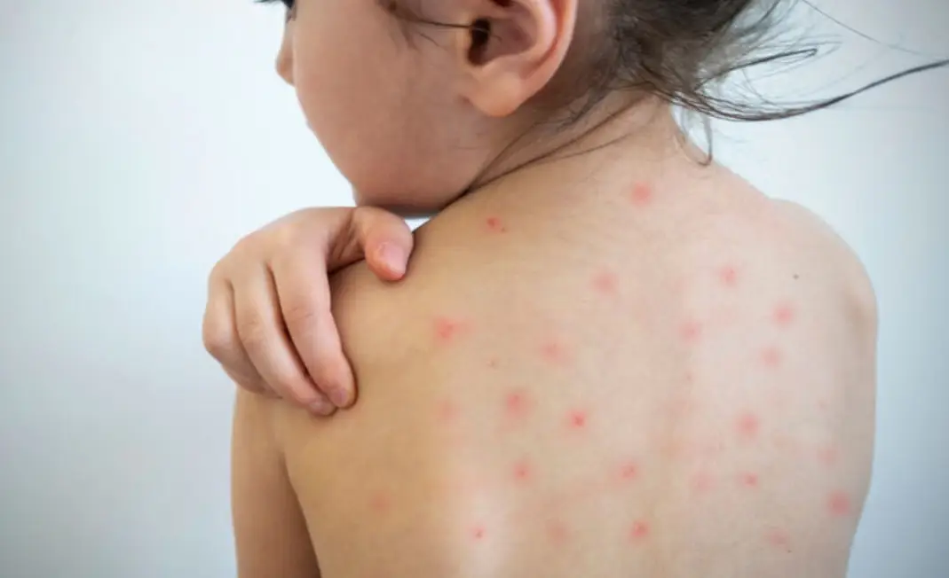 Brote de sarampión: refuerzan los controles en Misiones